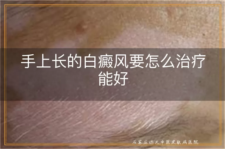 手上长的白癜风要怎么治疗能好