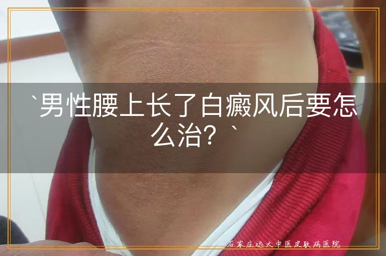 男性腰上长了白癜风后要怎么治？