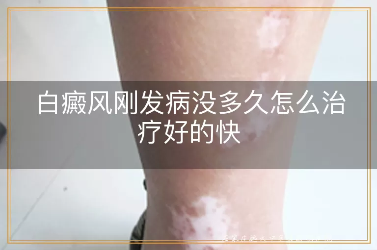 白癜风刚发病没多久怎么治疗好的快