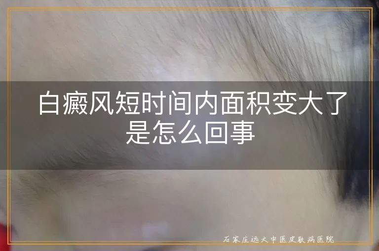 白癜风短时间内面积变大了是怎么回事