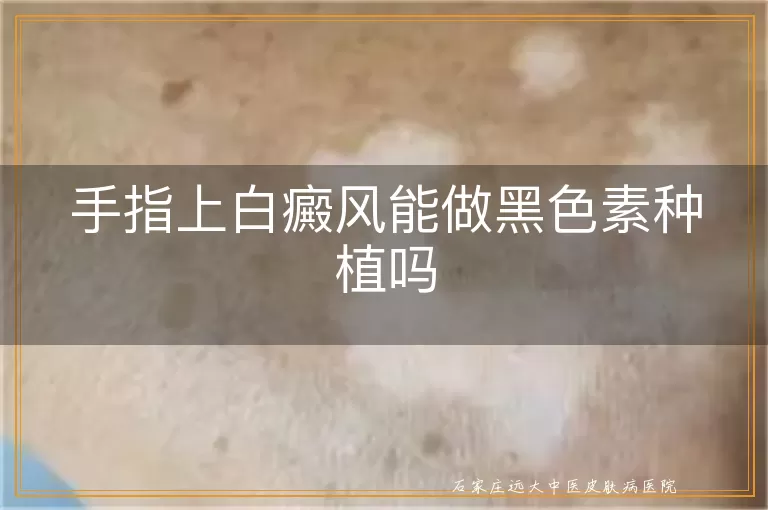 手指上白癜风能做黑色素种植吗