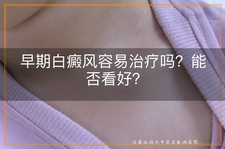 早期白癜风容易治疗吗？能否看好？