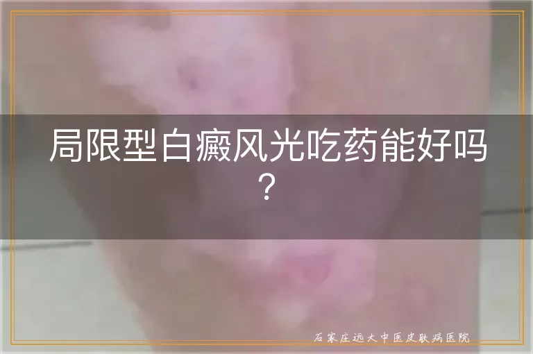 局限型白癜风光吃药能好吗？