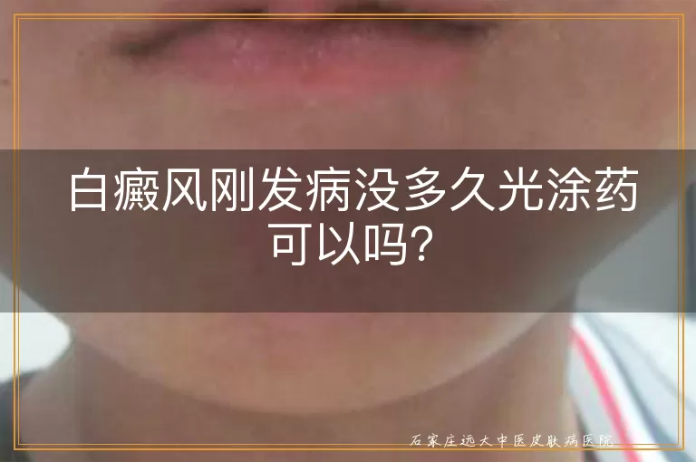 白癜风刚发病没多久光涂药可以吗？