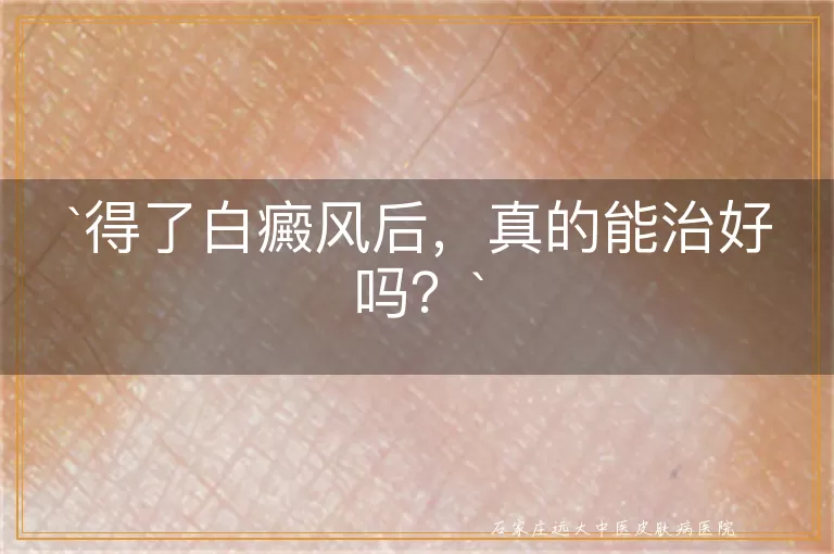 得了白癜风后，真的能治好吗？