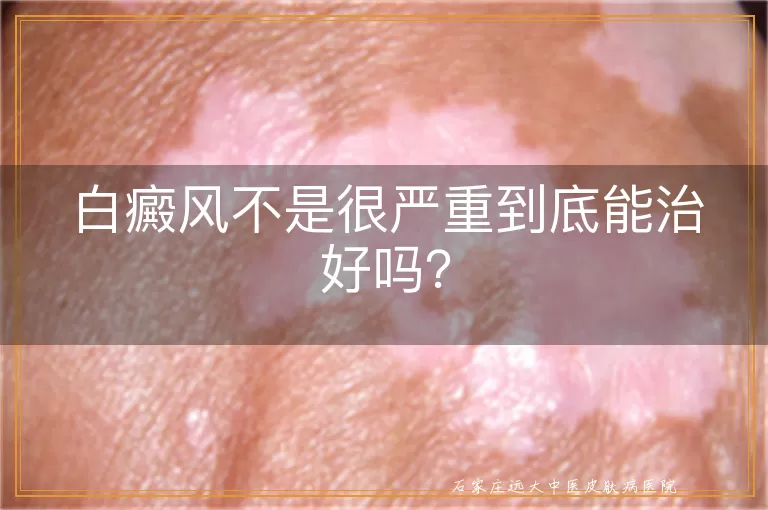 白癜风不是很严重到底能治好吗？