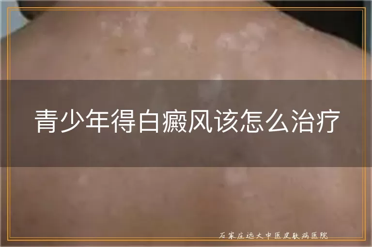 青少年得白癜风该怎么治疗