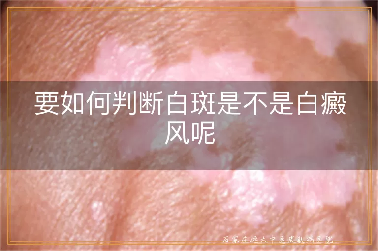 要如何判断白斑是不是白癜风呢