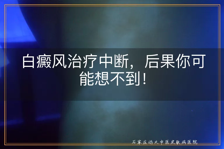 白癜风治疗中断，后果你可能想不到！