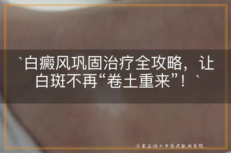 白癜风巩固治疗全攻略，让白斑不再“卷土重来”！