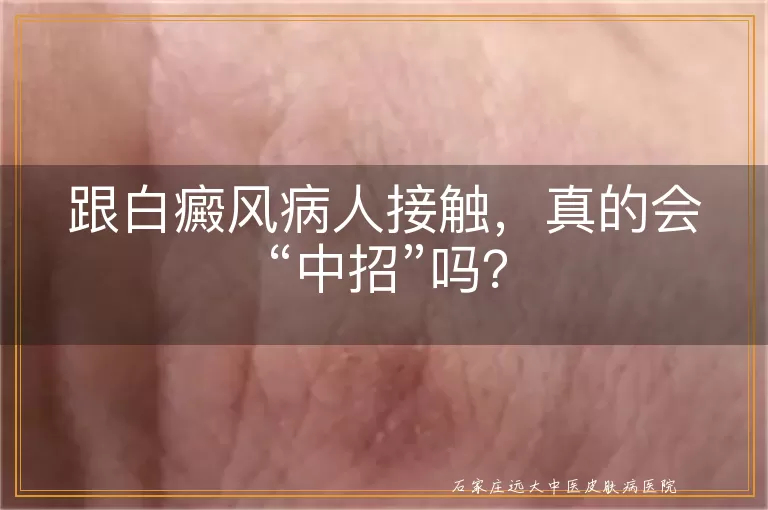 跟白癜风病人接触，真的会“中招”吗？
