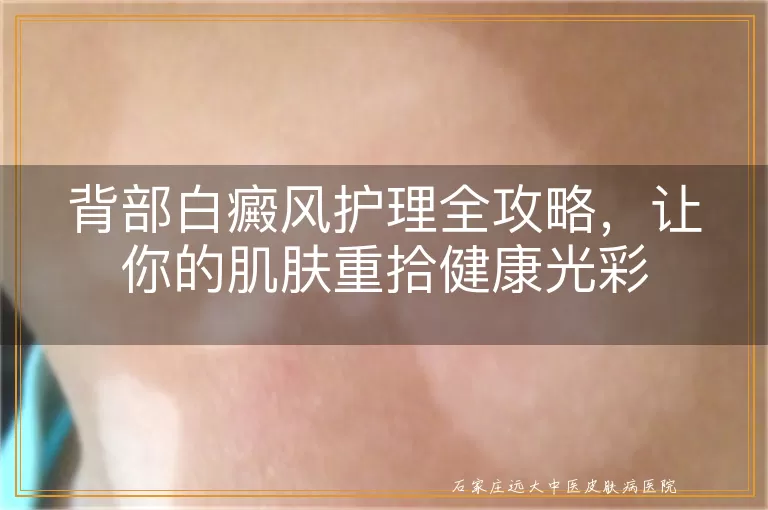 背部白癜风护理全攻略，让你的肌肤重拾健康光彩