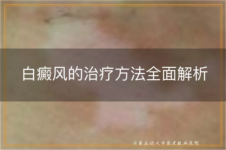 白癜风的治疗方法全面解析