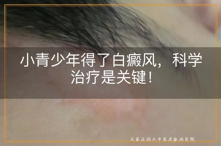 小青少年得了白癜风，科学治疗是关键！