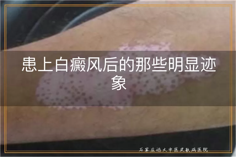 患上白癜风后的那些明显迹象