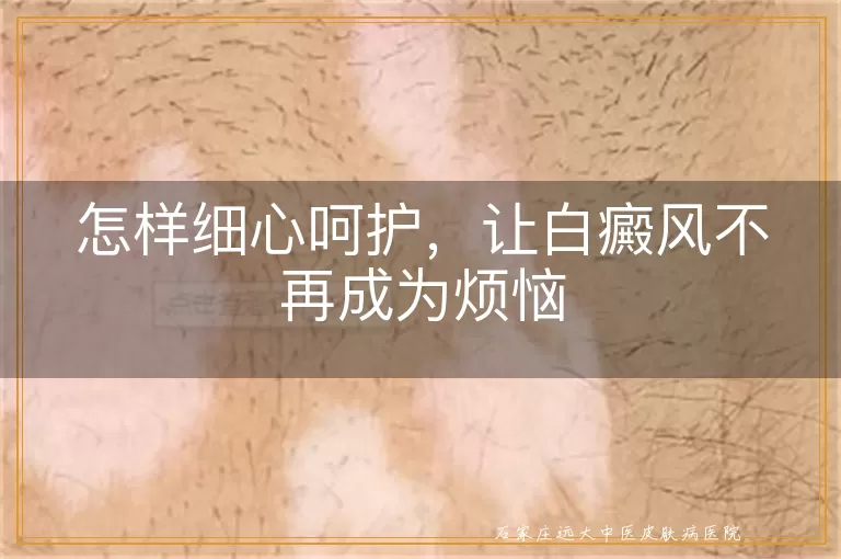 怎样细心呵护，让白癜风不再成为烦恼