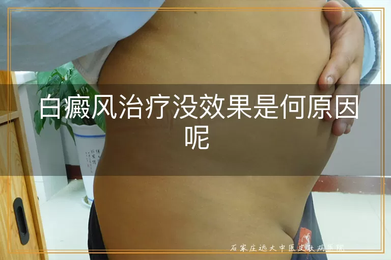 白癜风治疗没效果是何原因呢