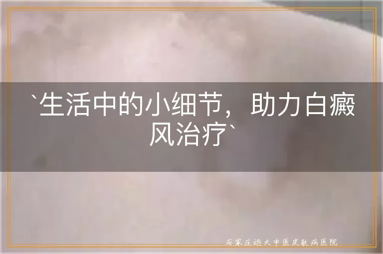 生活中的小细节，助力白癜风治疗