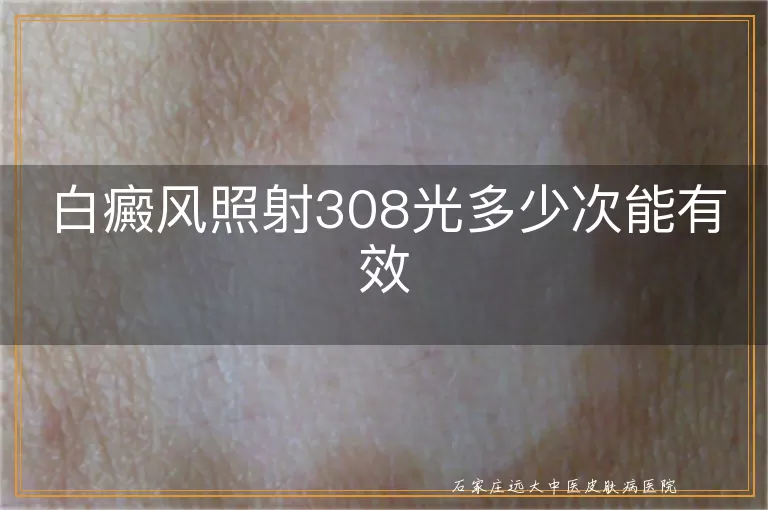 白癜风照射308光多少次能有效