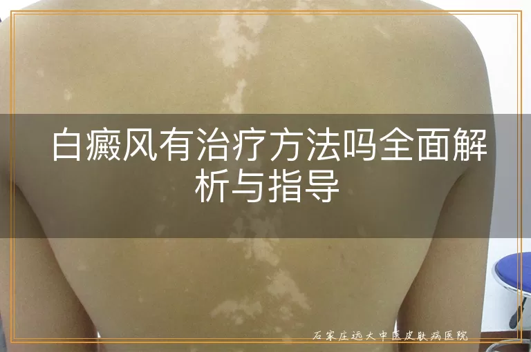 白癜风有治疗方法吗全面解析与指导