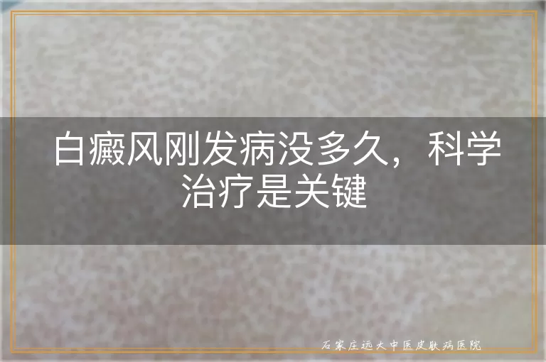 白癜风刚发病没多久，科学治疗是关键