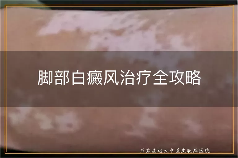 脚部白癜风治疗全攻略