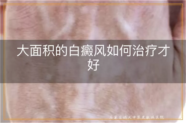 大面积的白癜风如何治疗才好