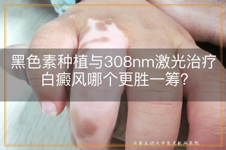 黑色素种植与308nm激光治疗白癜风哪个更胜一筹?