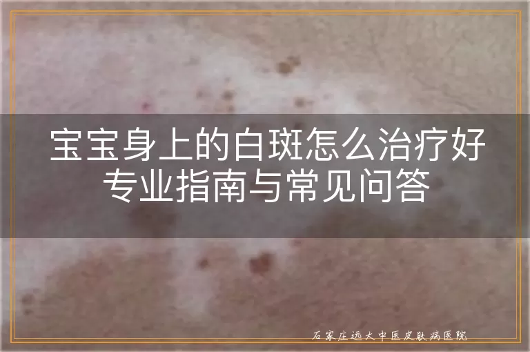 宝宝身上的白斑怎么治疗好专业指南与常见问答