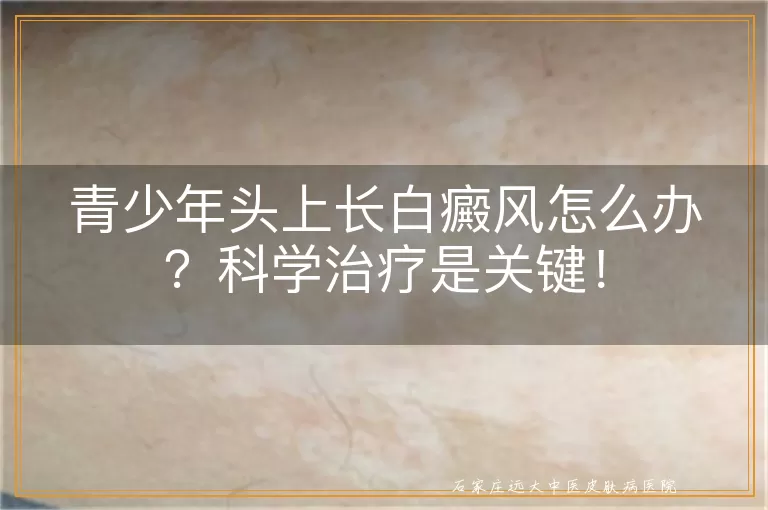 青少年头上长白癜风怎么办？科学治疗是关键！
