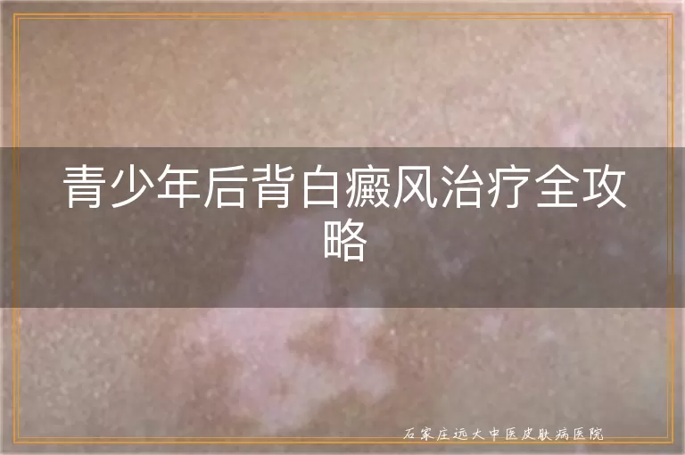 青少年后背白癜风治疗全攻略