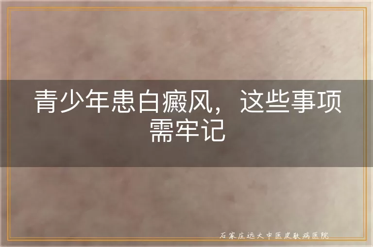 青少年患白癜风，这些事项需牢记
