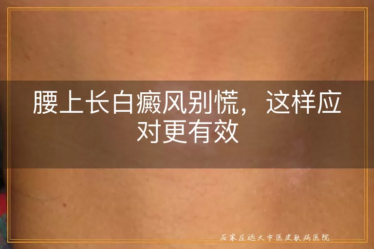 腰上长白癜风别慌，这样应对更有效