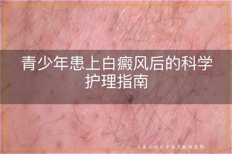 青少年患上白癜风后的科学护理指南