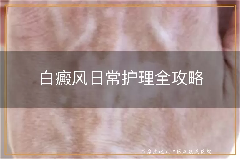 白癜风日常护理全攻略