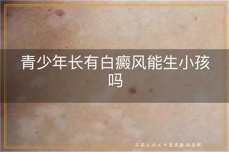 青少年长有白癜风能生小孩吗