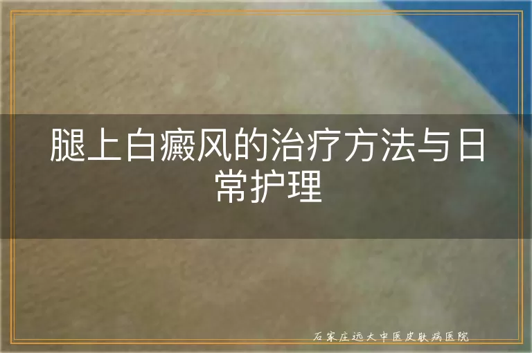 腿上白癜风的治疗方法与日常护理
