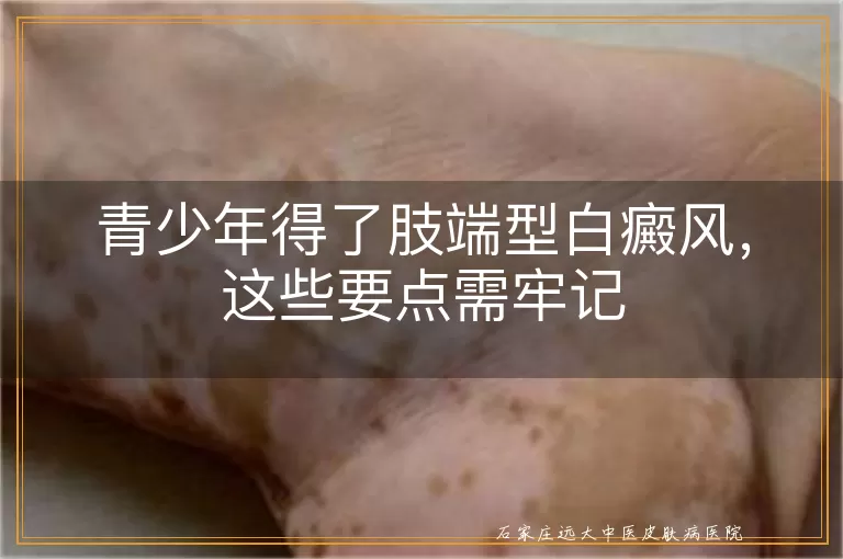 青少年得了肢端型白癜风，这些要点需牢记