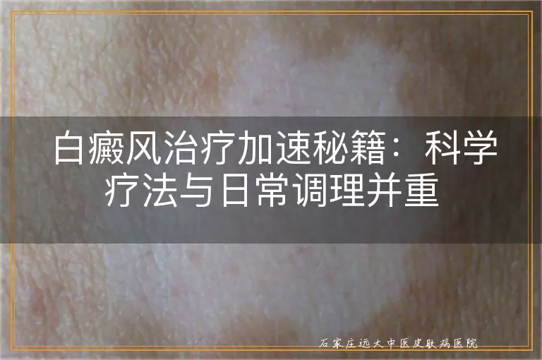 白癜风治疗加速秘籍：科学疗法与日常调理并重