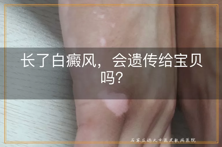 长了白癜风，会遗传给宝贝吗？