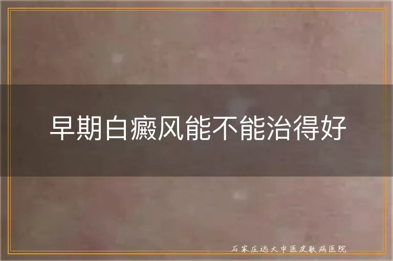 早期白癜风能不能治得好