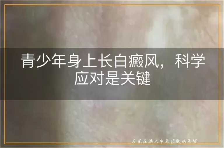 青少年身上长白癜风，科学应对是关键