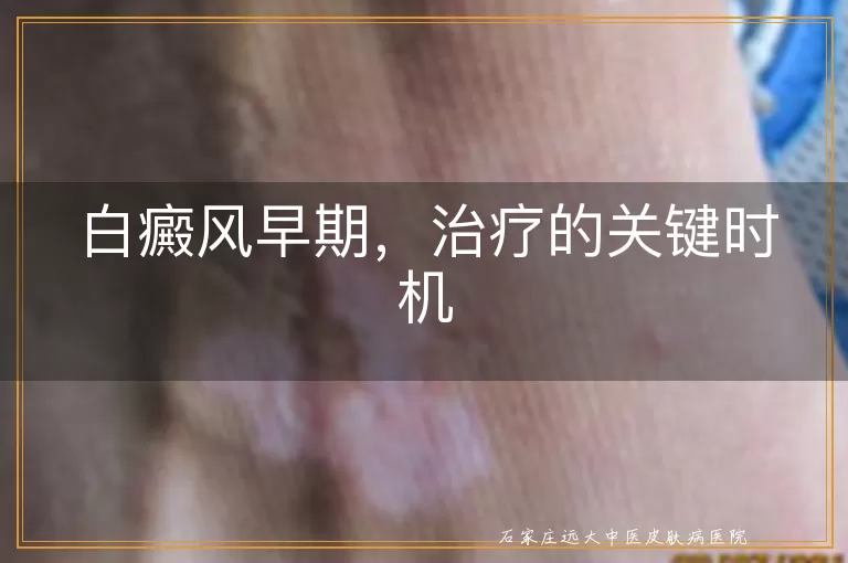 白癜风早期，治疗的关键时机