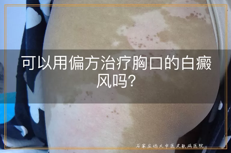 可以用偏方治疗胸口的白癜风吗？