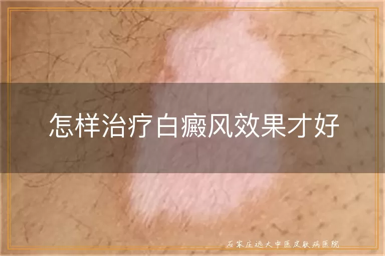 怎样治疗白癜风效果才好