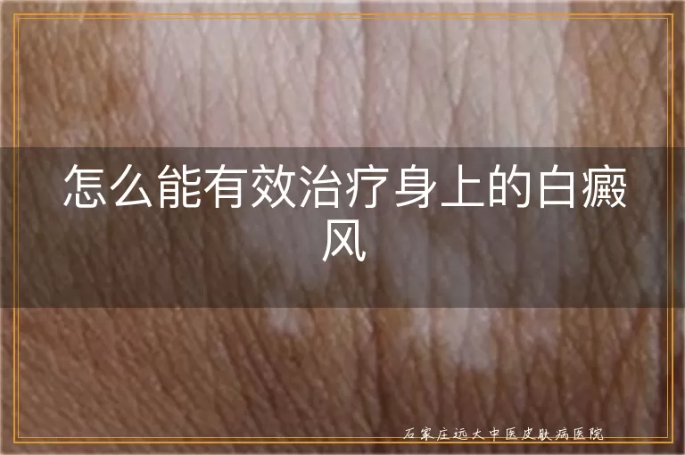 怎么能有效治疗身上的白癜风
