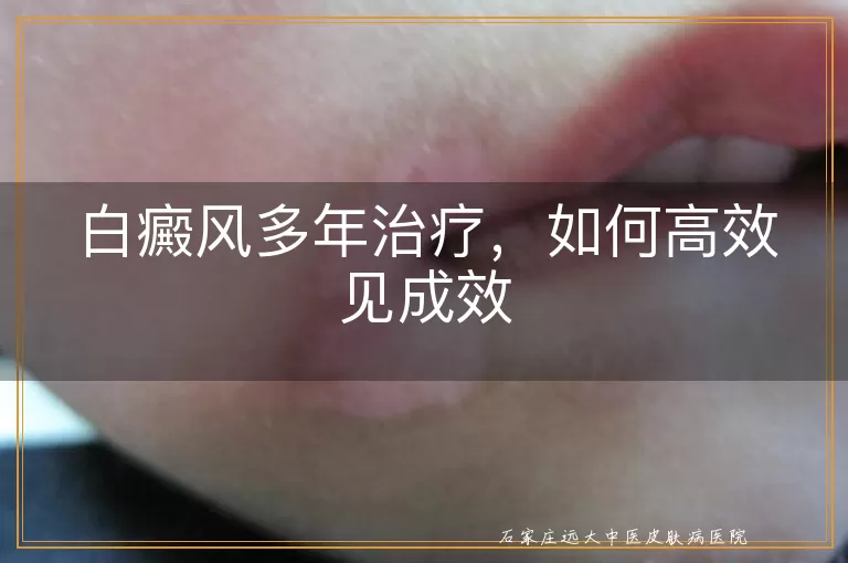 白癜风多年治疗，如何高效见成效