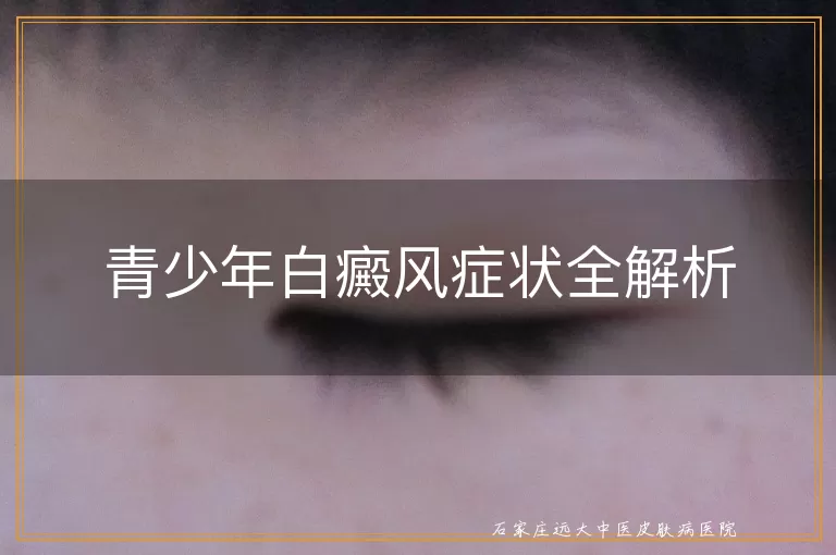 青少年白癜风症状全解析