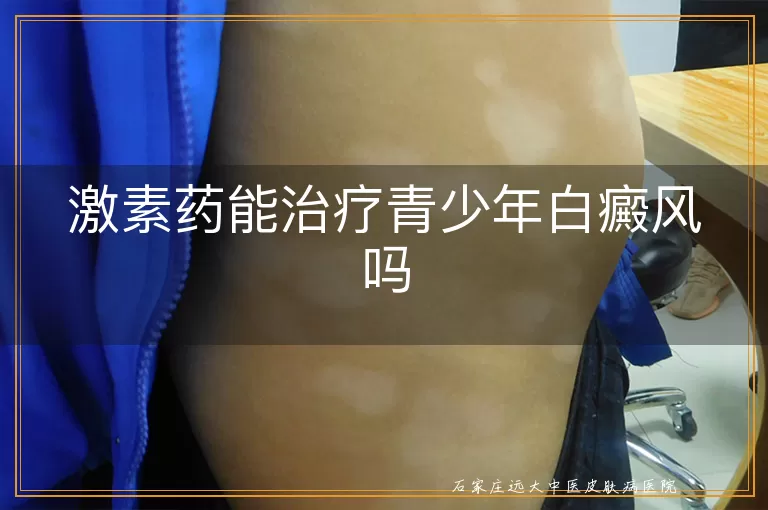 激素药能治疗青少年白癜风吗