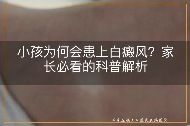 小孩为何会患上白癜风？家长必看的科普解析
